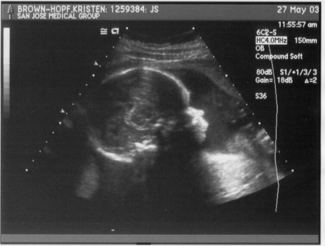 ultrasound5-27-03